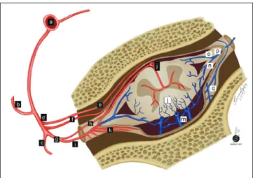 Fig. 1. Illustration of SDAVF at lower thoracic level.  Arteries are  labeled with black background, while veins are labeled with white  background