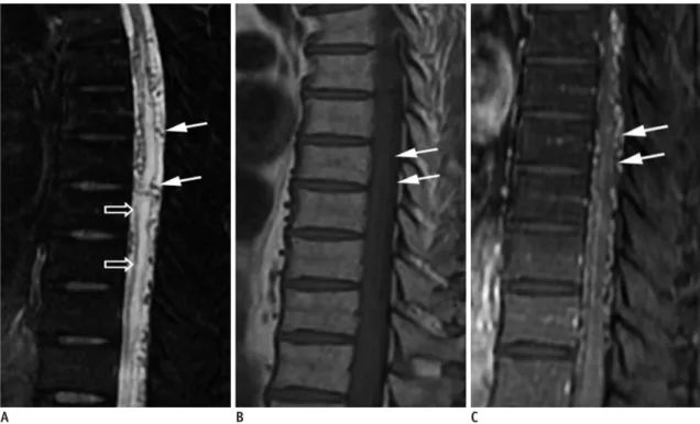 Fig. 2. Characteristic diagnostic clues of SDAVF on MRI. 