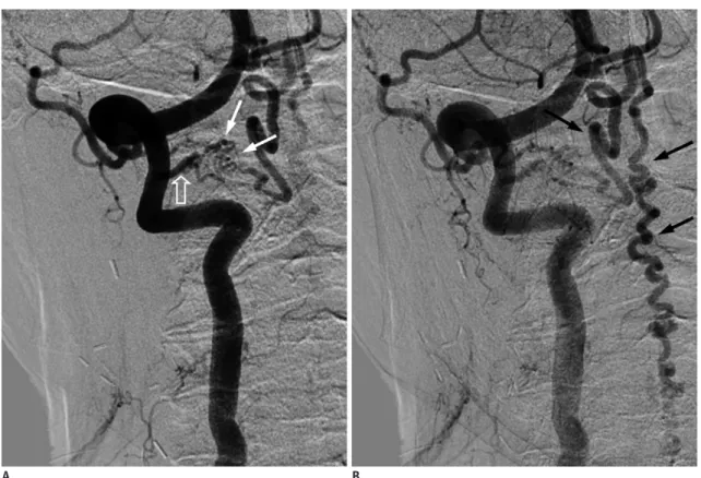 Fig. 4. Cervical SDAVF with feeding artery from right vertebral artery of 84-year-old man as incidental finding
