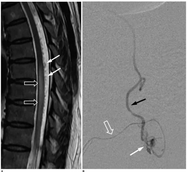 Fig. 5. Lumbar SDAVF with arterial feeding from left L2 lumbar artery of 53-year-old man presenting with bilateral weakness in  lower extremities and urinary bladder frequency