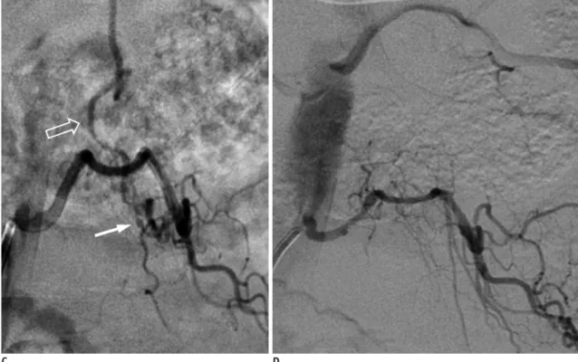 Fig. 5. Lumbar SDAVF with arterial feeding from left L2 lumbar artery of 53-year-old man presenting with bilateral weakness in  lower extremities and urinary bladder frequency
