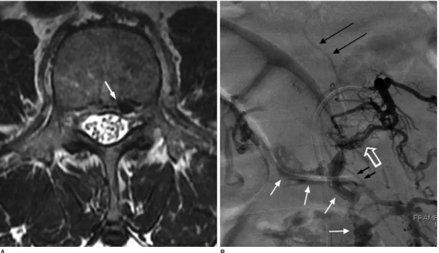 Fig. 8. 60-year-old man presenting with bilateral leg soreness for several months was diagnosed with SEAVF