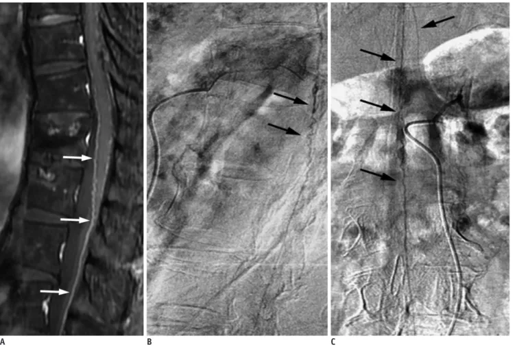 Fig. 11. Prominent left posterior spinal artery mimics SDAVF. 