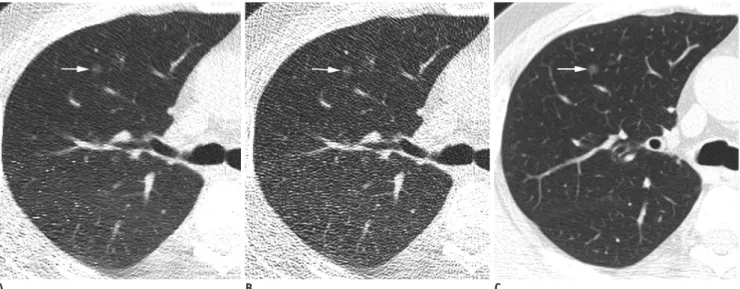 Fig. 2. Images of 45-year-old man with incidental pulmonary nodule show nodule with ground-glass opacity measuring 6 mm  (arrows) in diameter in right upper lobe.