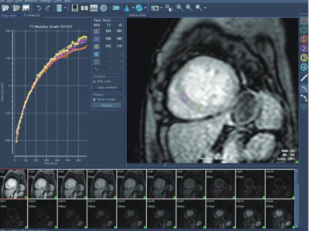 Fig. 1. Representative case of measuring post-T1 value in Look-Locker-based inversion time scout images.