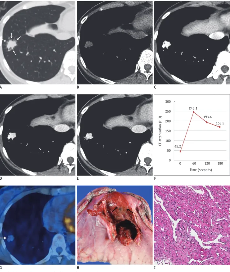 Fig. 1. 38-year-old woman with primary pulmonary angiosarcoma.