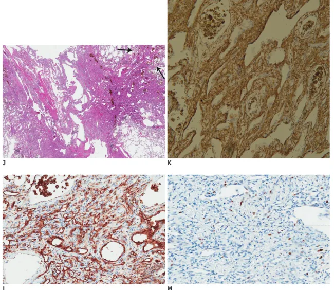 Fig. 1. 38-year-old woman with primary pulmonary angiosarcoma.