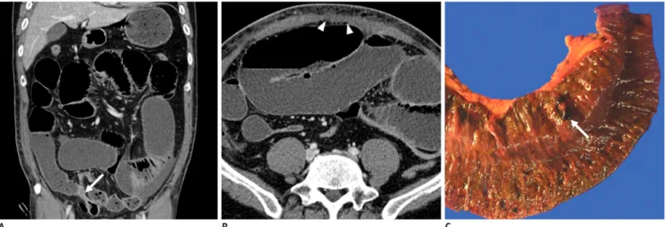Fig. 6. 47-year-old man presented with abdominal distension for 5 days and dyspnoea for 2 days