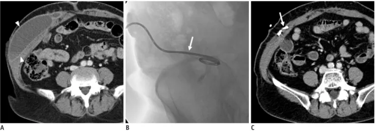Fig. 8. 64-year-old woman presented with abdominal pain and right abdominal wall bulging after liposuction