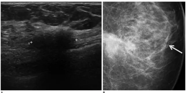 Fig. 1. Foreign body reaction in 61-year-old woman with history of breast augmentation and removal (material: unknown)