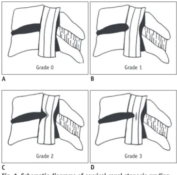 Fig. 1. Schematic diagrams of cervical canal stenosis grading  system (adapted from reference 29).