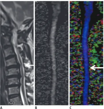 Fig. 5. Cervical spondylotic myelopathy (CSM) detected using  diffusion tensor imaging (DTI) parameters in patient whose  T2-weighted image was designated as showing as grade 2  stenosis.