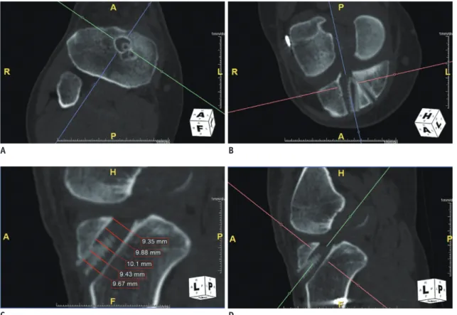 Fig. 1. Measurement of bone tunnel diameters with multiplanar reconstruction (MPR) method