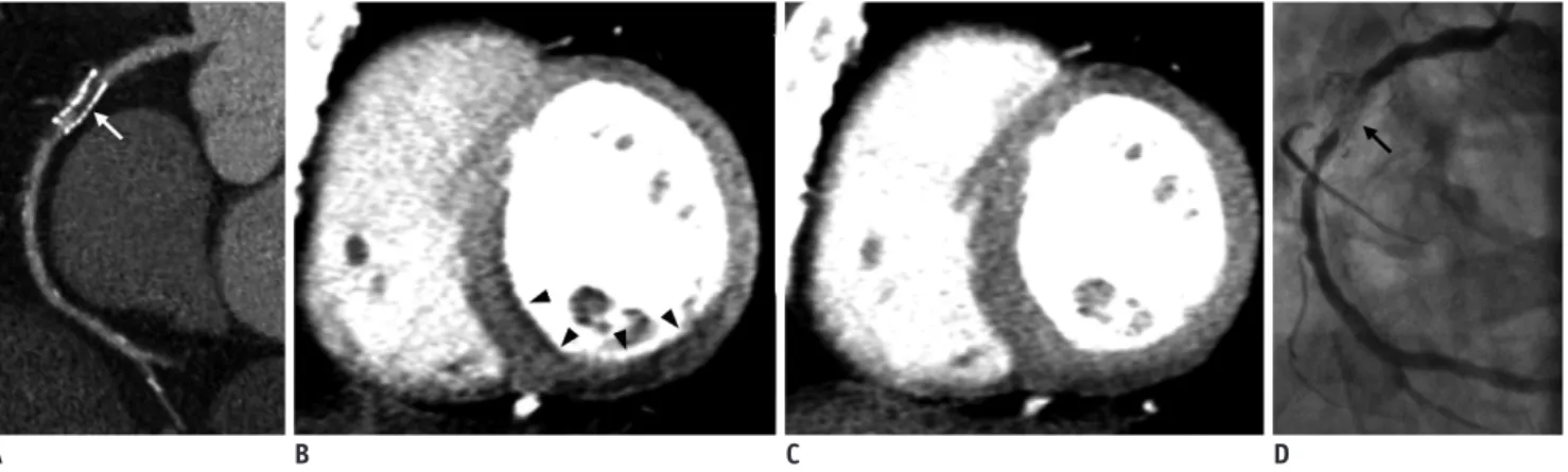 Fig. 1. Case of computed tomography (CT) myocardial  perfusion imaging.