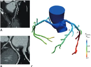 Fig. 4. Case of computed tomography-derived computed  fractional flow reserve (FFR CT ).