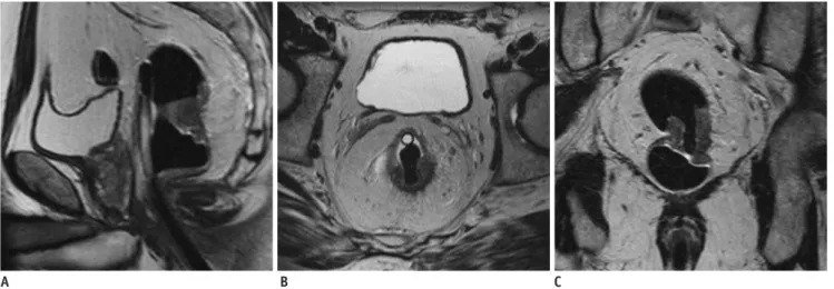 Fig. 5. Borderline T3 rectal cancer.