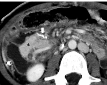 Fig. 3. Stapling device.  Stapling devices are usually used for both  proximal and distal ends of donor duodenum, and these radiodense  devices may offer good landmarks to localize duodenum and pancreatic  head quickly on computed tomography scan (white ar