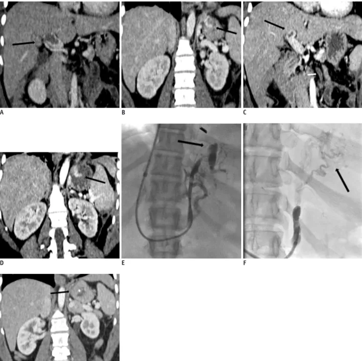 Fig. 1. 35-year-old women with history of Crohn’s disease, status post total abdominal colectomy, and portal vein and mesenteric  vein thrombosis