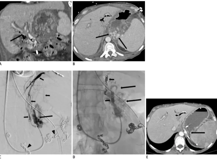Fig. 2. 51-year-old women with necrotizing pancreatitis, portal vein thrombosis, and gastric varices.