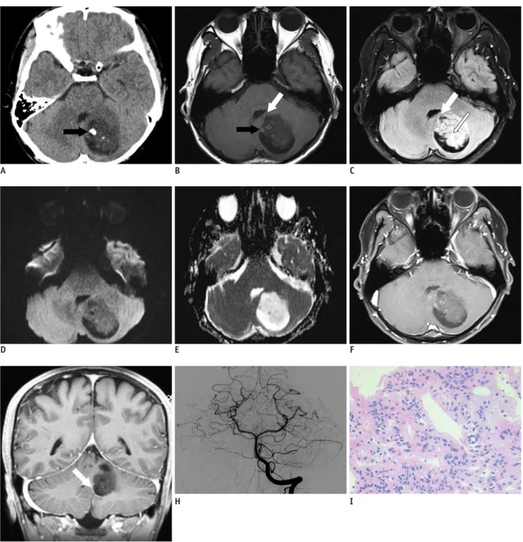 Fig. 1. Imaging features of cerebellar subependymoma in 28-year-old man.