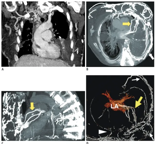 Fig. 1. Multidetector computed tomographic venography images of chest in 54-year-old woman with complete SVC obstruction  and abundant venous collaterals