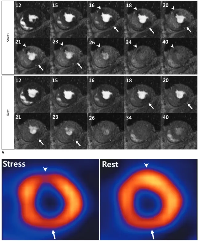 Fig. 1. Two different perfusion defects on MR, SPECT and perfusion MR analysis.