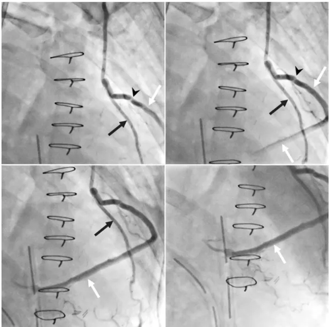Fig. 1. Two different perfusion defects on MR, SPECT and perfusion MR analysis.