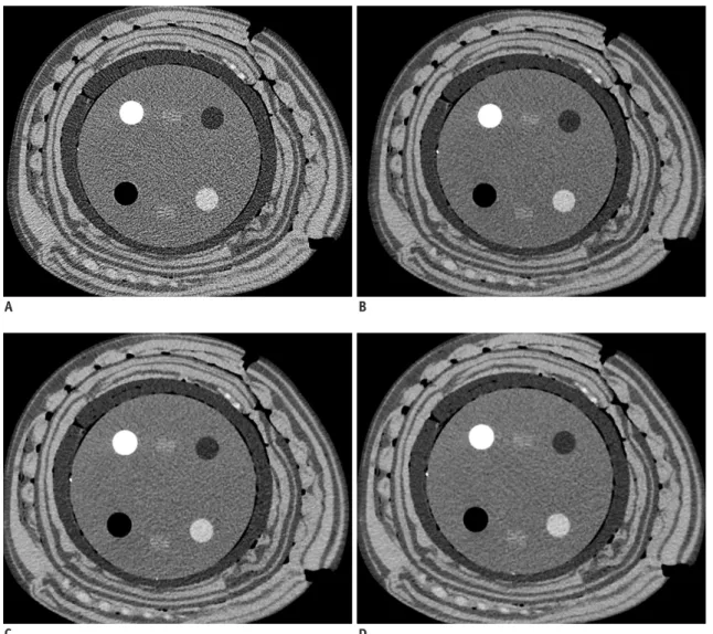Fig. 4. CT images of 40-cm phantom scanned with tube current time product of 180 mAs reconstructed with filtered back  projection (A), adaptive iterative dose reduction three-dimensional mild (B), standard (C), and strong modes (D)