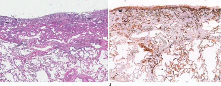 Fig. 1. 52-year-old woman with diffuse pulmonary lymphangiomatosis.