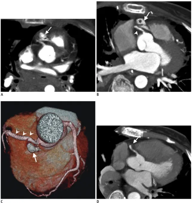 Fig. 1. 53-year-old female diagnosed with right ventricle pseudoaneurysm after 20-meter fall.