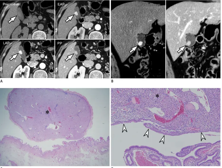 Fig. 3. Polypoid type metastatic gallbladder (GB) cancer from renal cell carcinoma (RCC) in 50-year-old man