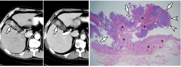 Fig. 4. Polypoid type metastatic gallbladder (GB) cancer from hepatocellular carcinoma (HCC) in 75-year-old man