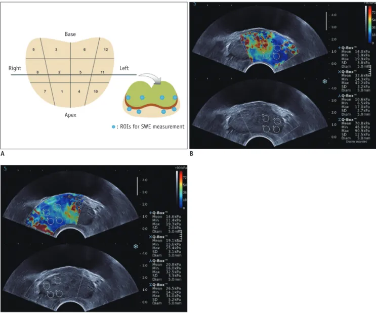 Fig. 1. Distribution of 12 sectors for systematic 12-core biopsy and acquisition of shear wave elastographic (SWE) parameters