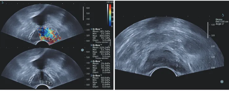 Fig. 2. 80-year-old man with prostate cancer in focal lesion with hypoechogenicity and elevated stiffness on shear wave  elastography.