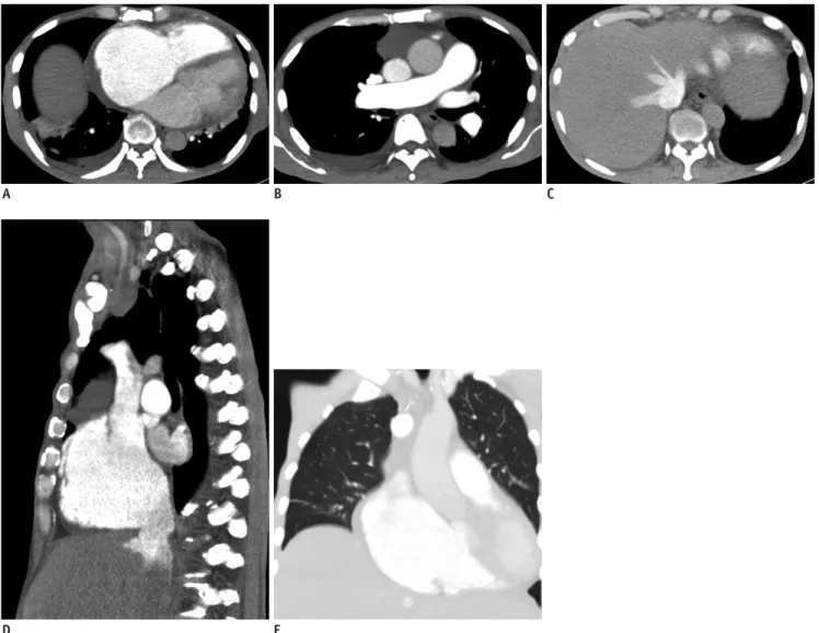 Fig. 1. 66-year-old man with primary myelofibrosis.