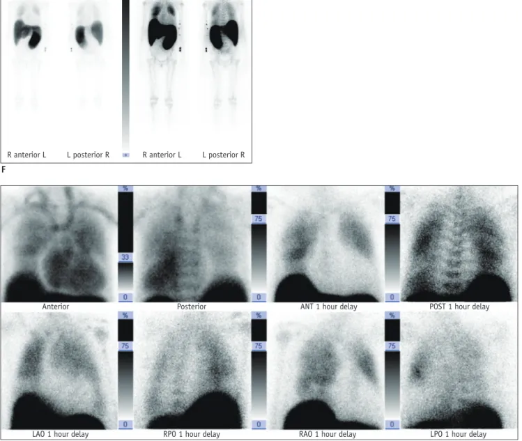Fig. 1. 66-year-old man with primary myelofibrosis.