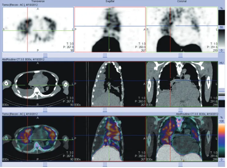 Fig. 1. 66-year-old man with primary myelofibrosis.