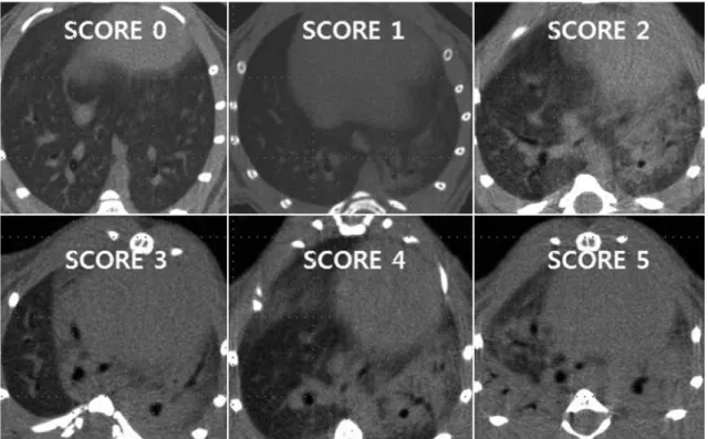 Fig. 3. Example of scoring of severity of consolidation on micro-CT.  Severity of findings on imaging before and after rosiglitazone  instillation in bleomycin-induced fibrosis mice model was semiquantitatively assessed on five-point scale