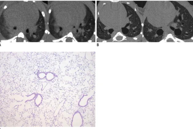 Fig. 6. Case of complete improvement of lung fibrosis after administration of rosiglitazone shown on micro-CT.