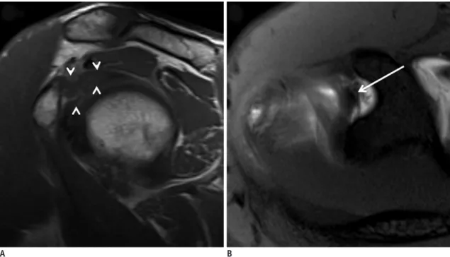 Fig. 16. Habermeyer group 4 lesion in 55-year-old man.
