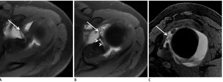 Fig. 18. Type X SLAP lesion with SGHL tear in 43-year-old man.