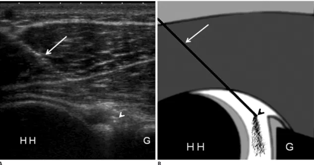 Fig. 1. Ultrasonography-guided posterior injection technique for shoulder MR arthrography.