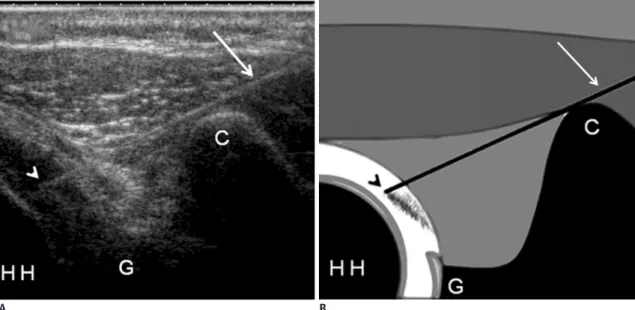 Fig. 2. Ultrasonography-guided rotator interval injection technique for shoulder MR arthrography.