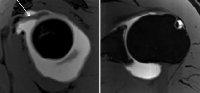 Fig. 10. Thick SGHL and thin MGHL in 43-year-old man who suffered from shoulder pain.  Consecutive oblique sagittal fat-saturated 3D  VIBE MR arthrographic images show thick SGHL (white arrow) and thin MGHL (black dotted arrow)