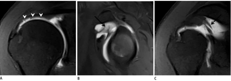 Fig. 12. Partial tear of undersurface of supraspinatus tendon with SGHL tear in 47-year-old man.