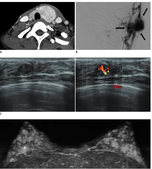 Fig. 1. Left breast cancer, multiple bilateral benign breast masses, left thyroid cancer and arteriovenous malformation (AVM) in  left parotid gland in 22-year-old woman with Cowden syndrome