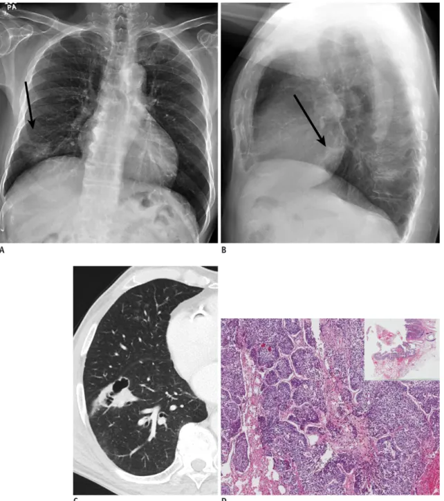 Fig. 1. 72-year-old man with synchronous triple primary lung cancers.