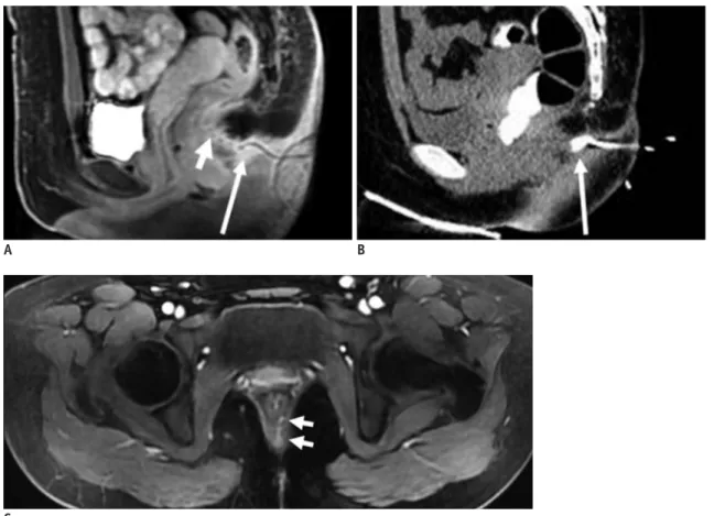 Fig. 10. 25-year-old female with fistula.