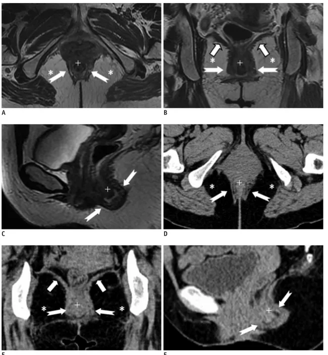 Fig. 1. Normal perianal anatomy of 47-year-old female volunteer imaged with CT and MR imaging