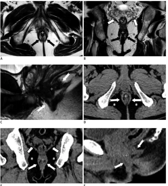 Fig. 2. Normal perianal anatomy of 45-year-old male volunteer imaged with CT and MR imaging.